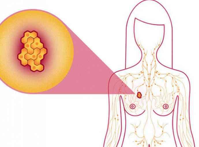 පියයුරු පිළිකා නසන එන්නතක් නිපදවයි